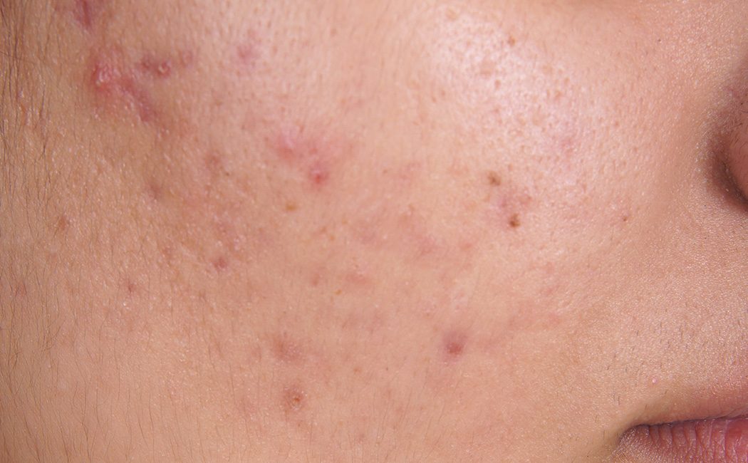 acne filled skin